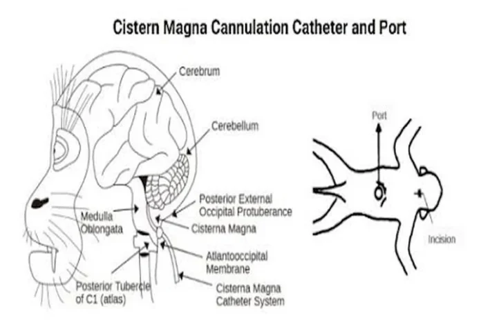 Can Intrathecal Therapy Treat Chronic Pain Therapy