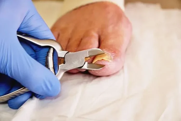 When Ingrown Toenail Removal Becomes a Must Key Warning Signs Ingrown Toenail