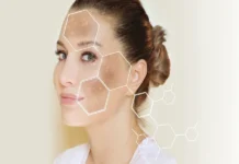 Top Melasma Treatment for Sun-Induced Melasma in Singapore’s Climate