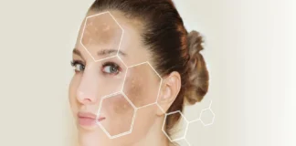 Top Melasma Treatment for Sun-Induced Melasma in Singapore’s Climate