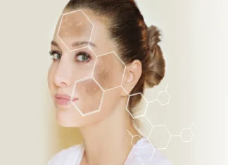 Top Melasma Treatment for Sun-Induced Melasma in Singapore’s Climate