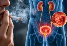 Smoking and Bladder Cancer: The Link Most Patients Don’t Know About