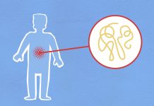 Understanding Diverticular Disease With A Colon Doctor Singapore