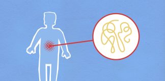 Understanding Diverticular Disease With A Colon Doctor Singapore