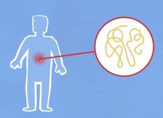 Understanding Diverticular Disease With A Colon Doctor Singapore
